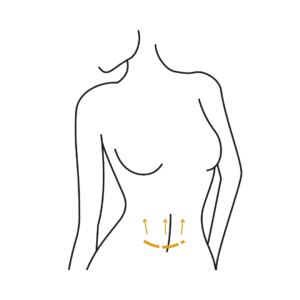 Woman's body illustration highlighting the location of the Tummy Tuck Surgery