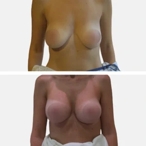 تكبير الثدي تكبير الصدر تجميل الثدي تجميل الصدر