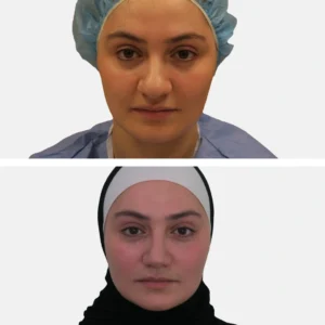 تجميل الأنف عملية تجميل الأنف تجميل الانف تجميل الخشم