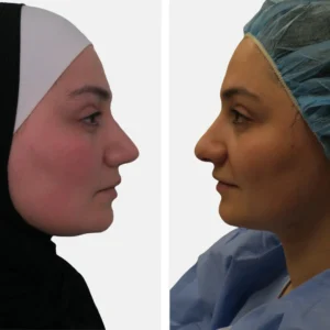 تجميل الأنف عملية تجميل الأنف تجميل الانف تجميل الخشم