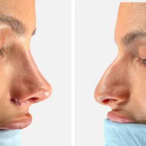 تجميل الأنف عملية تجميل الأنف تجميل الانف تجميل الخشم