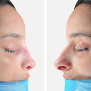 تجميل الأنف عملية تجميل الأنف تجميل الانف تجميل الخشم